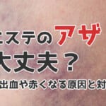 痩身エステでアザだらけ？内出血や赤くなる原因と対処法