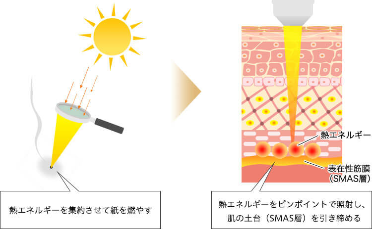 ハイフ（HIFU）の仕組み