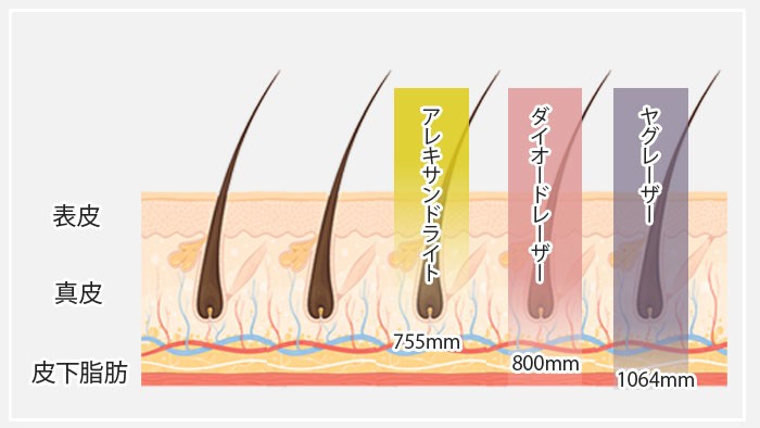 現在医療脱毛で使われているレーザーは主に３種類